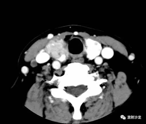 【病例】甲状腺癌1例CT影像表现 【病例】甲状腺癌1例CT影像表现