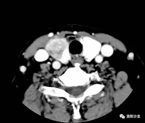 【病例】甲状腺癌1例CT影像表现 【病例】甲状腺癌1例CT影像表现