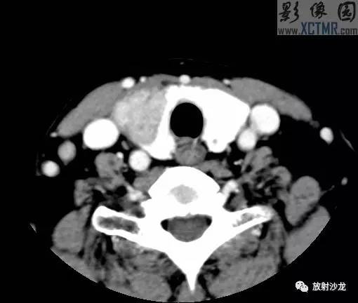 【病例】甲状腺癌1例CT影像表现 【病例】甲状腺癌1例CT影像表现