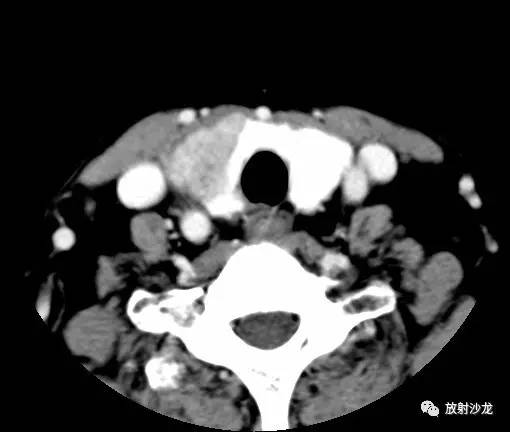 【病例】甲状腺癌1例CT影像表现 【病例】甲状腺癌1例CT影像表现