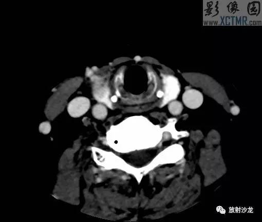 【病例】甲状腺癌1例CT影像表现 【病例】甲状腺癌1例CT影像表现