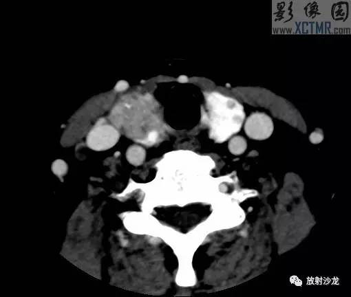 【病例】甲状腺癌1例CT影像表现 【病例】甲状腺癌1例CT影像表现