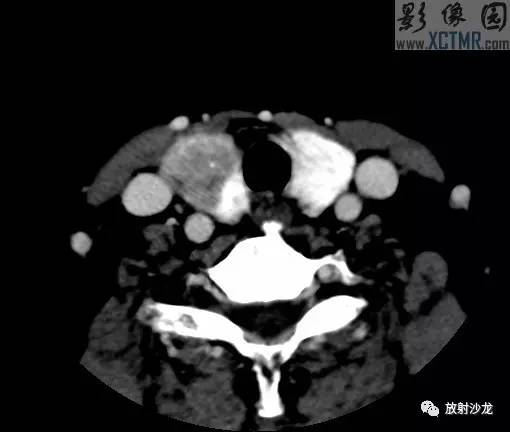 【病例】甲状腺癌1例CT影像表现 【病例】甲状腺癌1例CT影像表现