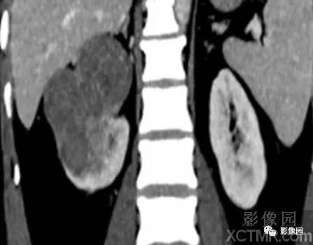 【病例】右肾癌1例CT影像诊断分析 【病例】右肾癌1例CT影像诊断分析