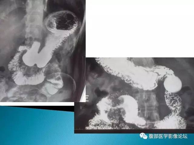 【病例】小肠占位3例X线CT影像表现