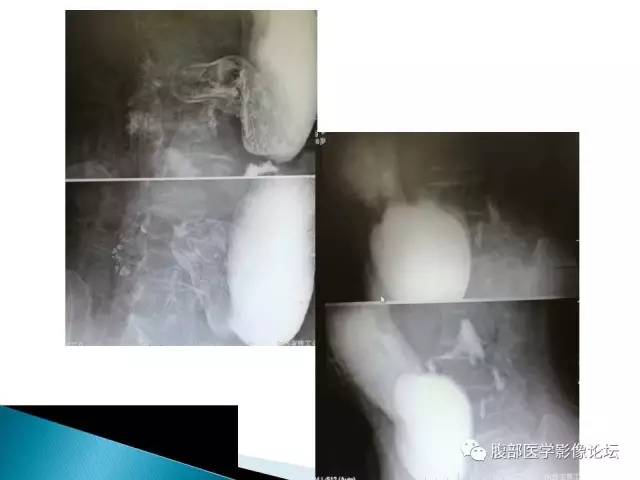 【病例】小肠占位3例X线CT影像表现