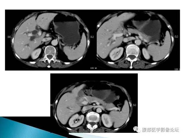 【病例】小肠占位3例X线CT影像表现
