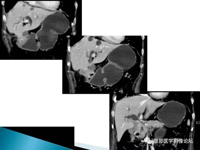 【病例】小肠占位3例X线CT影像表现