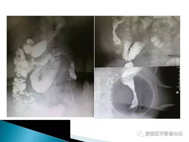【病例】小肠占位3例X线CT影像表现