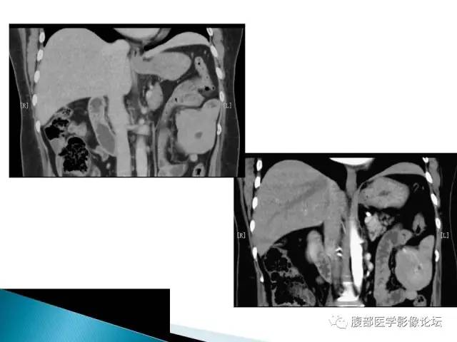 【病例】小肠占位3例X线CT影像表现