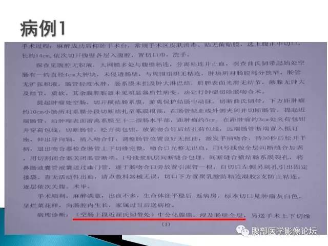 【病例】小肠占位3例X线CT影像表现