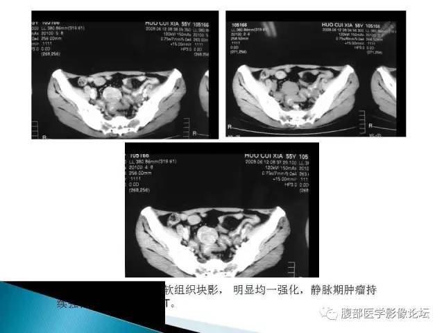 【病例】小肠占位3例X线CT影像表现