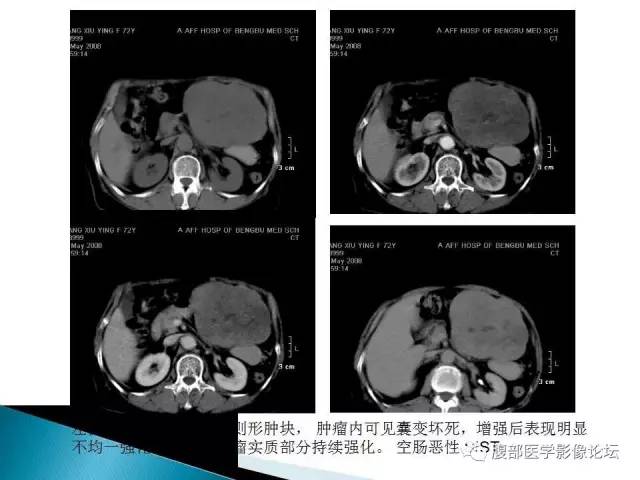 【病例】小肠占位3例X线CT影像表现