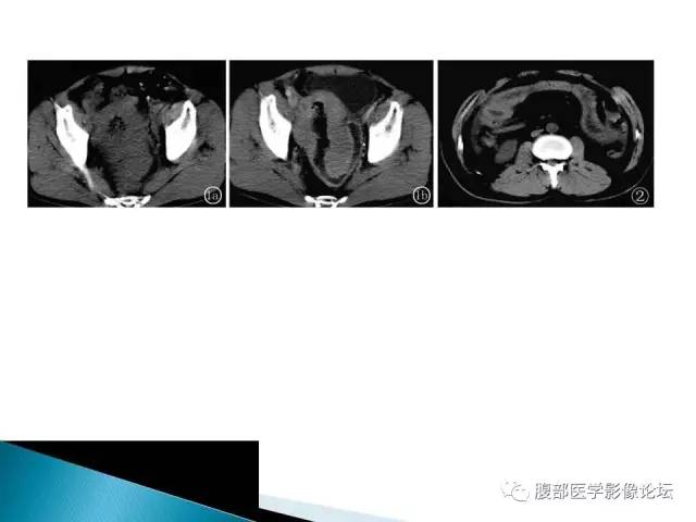 【病例】小肠占位3例X线CT影像表现