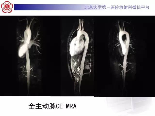 【病例】双侧锁骨下动脉动脉炎1例MR