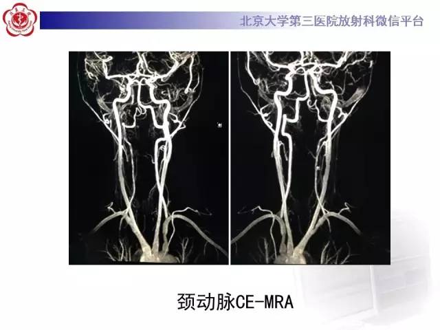 【病例】双侧锁骨下动脉动脉炎1例MR