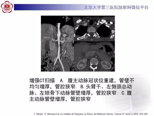 【病例】双侧锁骨下动脉动脉炎1例MR