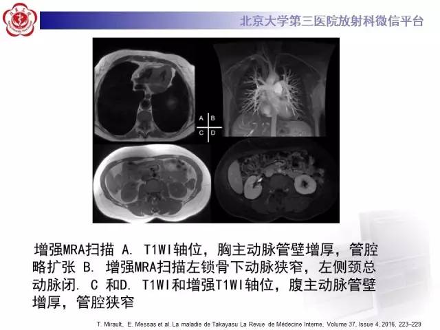 【病例】双侧锁骨下动脉动脉炎1例MR
