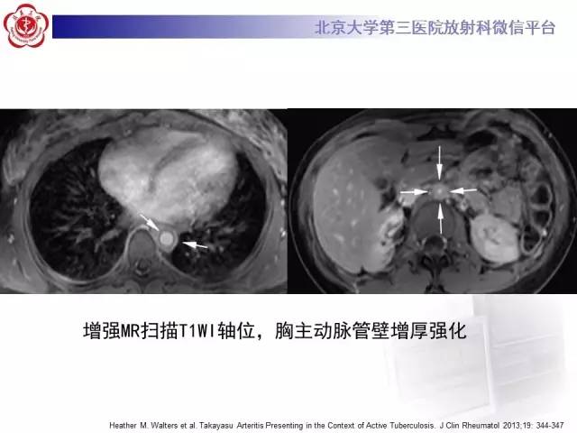 【病例】双侧锁骨下动脉动脉炎1例MR