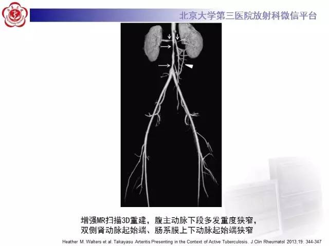 【病例】双侧锁骨下动脉动脉炎1例MR