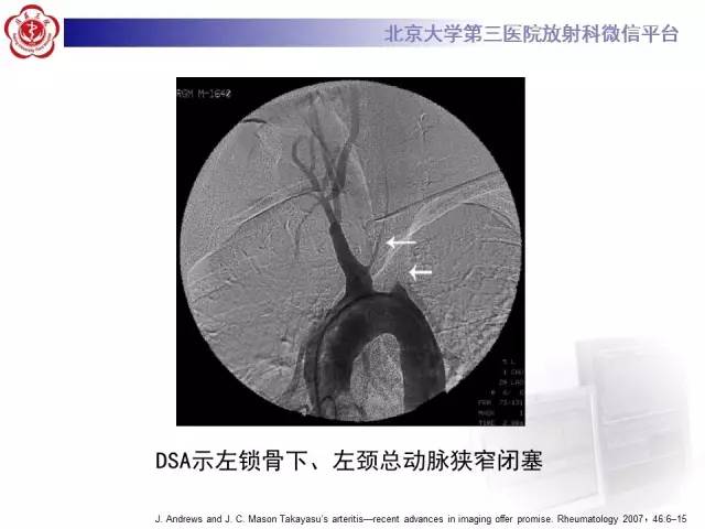【病例】双侧锁骨下动脉动脉炎1例MR