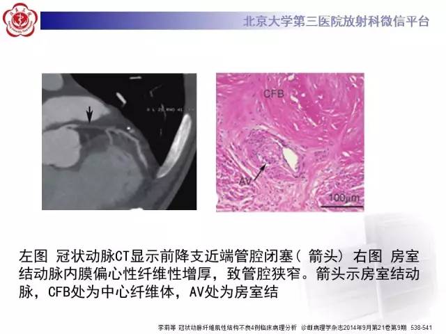 【病例】双侧锁骨下动脉动脉炎1例MR