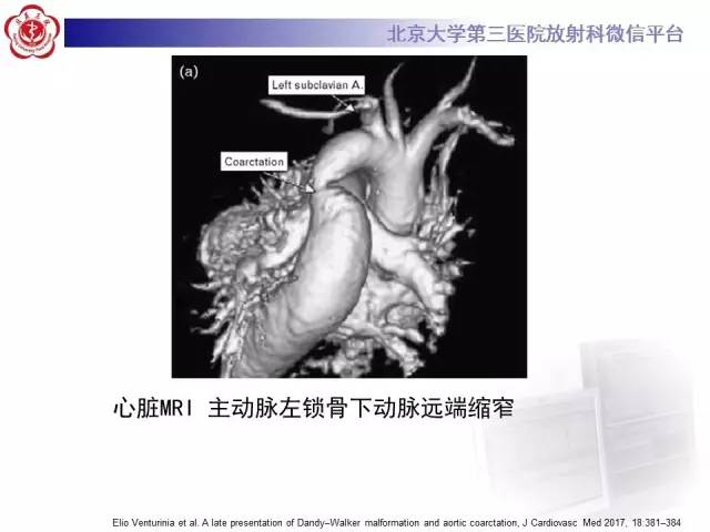 【病例】双侧锁骨下动脉动脉炎1例MR