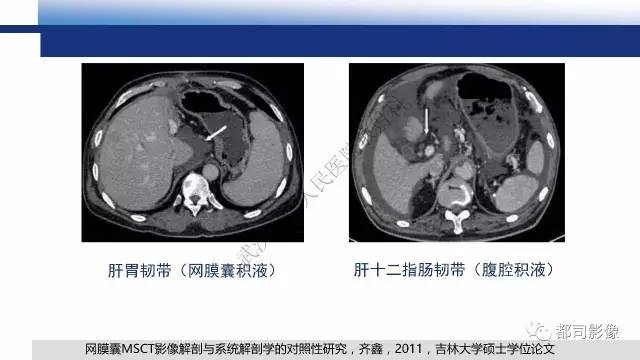【PPT】腹膜解剖及其炎性病变影像诊断