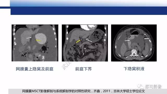 【PPT】腹膜解剖及其炎性病变影像诊断