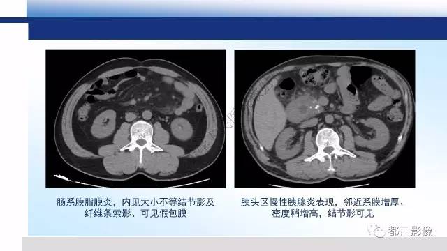 【PPT】腹膜解剖及其炎性病变影像诊断