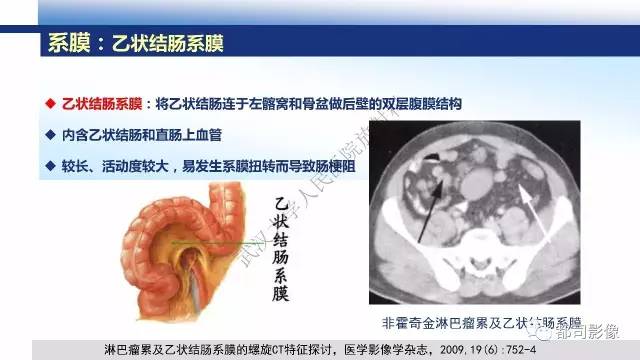 【PPT】腹膜解剖及其炎性病变影像诊断