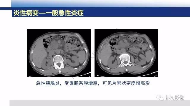 【PPT】腹膜解剖及其炎性病变影像诊断