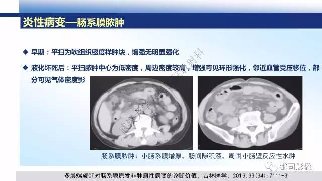 【PPT】腹膜解剖及其炎性病变影像诊断