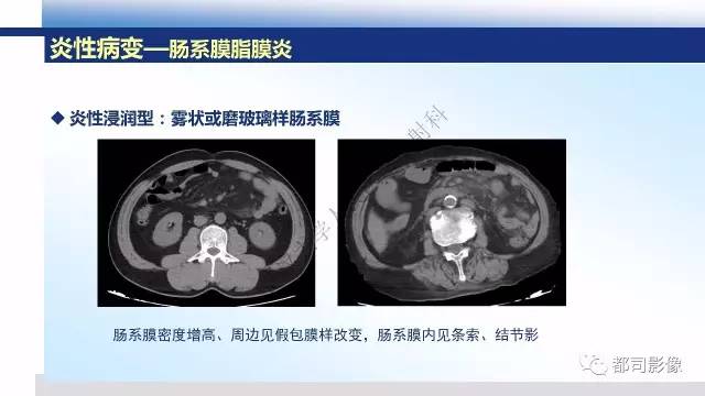 【PPT】腹膜解剖及其炎性病变影像诊断