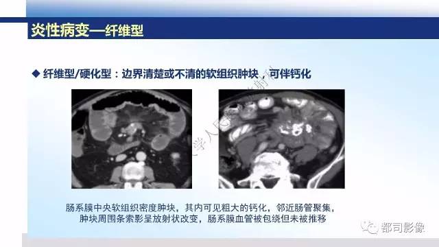 【PPT】腹膜解剖及其炎性病变影像诊断