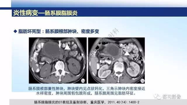 【PPT】腹膜解剖及其炎性病变影像诊断