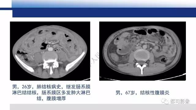 【PPT】腹膜解剖及其炎性病变影像诊断