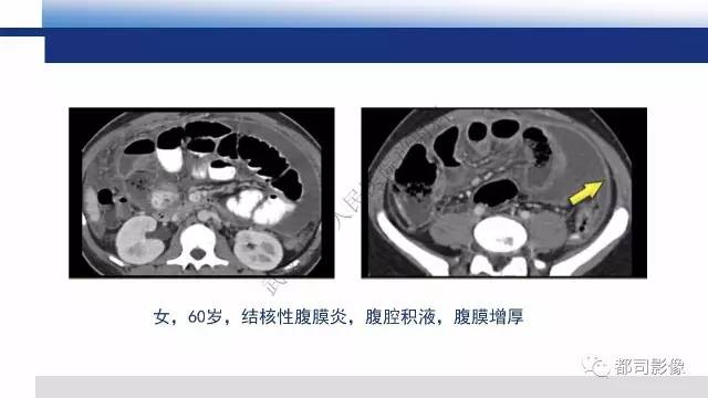 【PPT】腹膜解剖及其炎性病变影像诊断