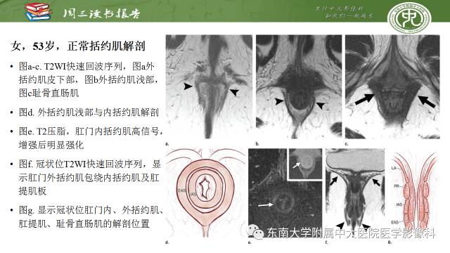 【PPT】克罗恩病肛周病变的MR表现