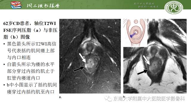 【PPT】克罗恩病肛周病变的MR表现