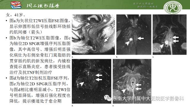 【PPT】克罗恩病肛周病变的MR表现