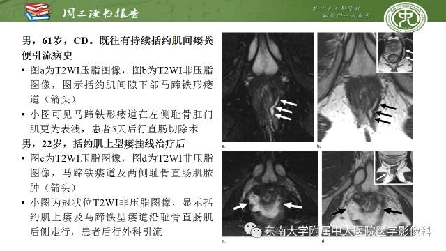【PPT】克罗恩病肛周病变的MR表现