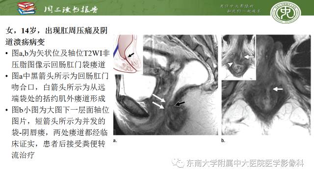 【PPT】克罗恩病肛周病变的MR表现