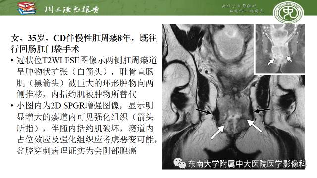 【PPT】克罗恩病肛周病变的MR表现