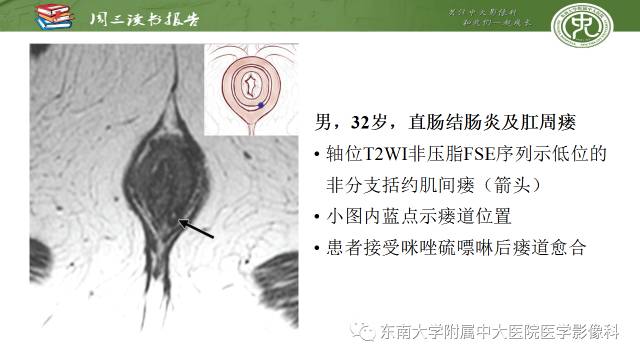 【PPT】克罗恩病肛周病变的MR表现