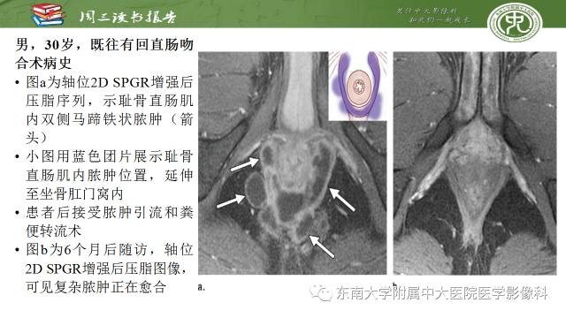 【PPT】克罗恩病肛周病变的MR表现