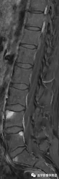 Shiny corner sign (ankylosing spondylitis)——亮角征（强直性脊柱炎）