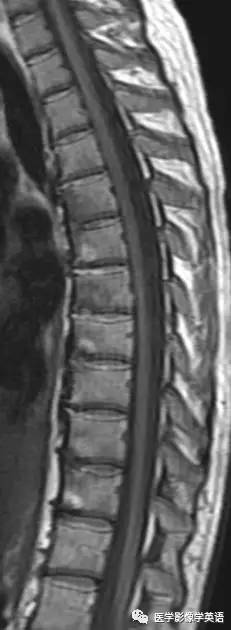 Shiny corner sign (ankylosing spondylitis)——亮角征（强直性脊柱炎）