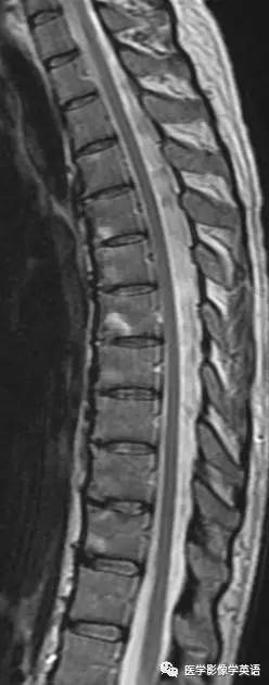 Shiny corner sign (ankylosing spondylitis)——亮角征（强直性脊柱炎）