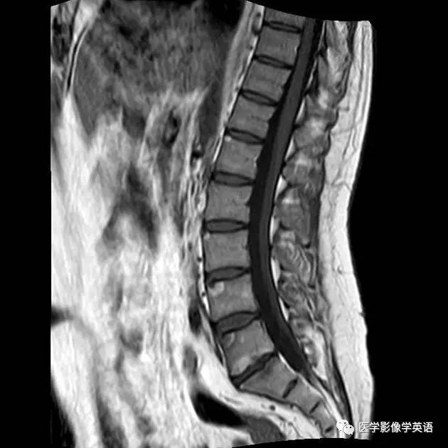 Shiny corner sign (ankylosing spondylitis)——亮角征（强直性脊柱炎）